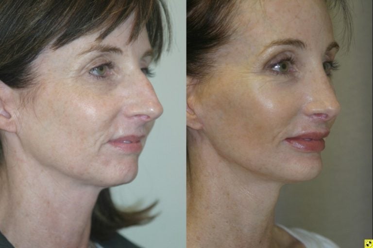 rhinoplasty-chin-implant-browlift-facelift-oblique