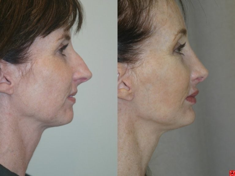 Rhinoplasty-chin-implant-browlift-facelift-side