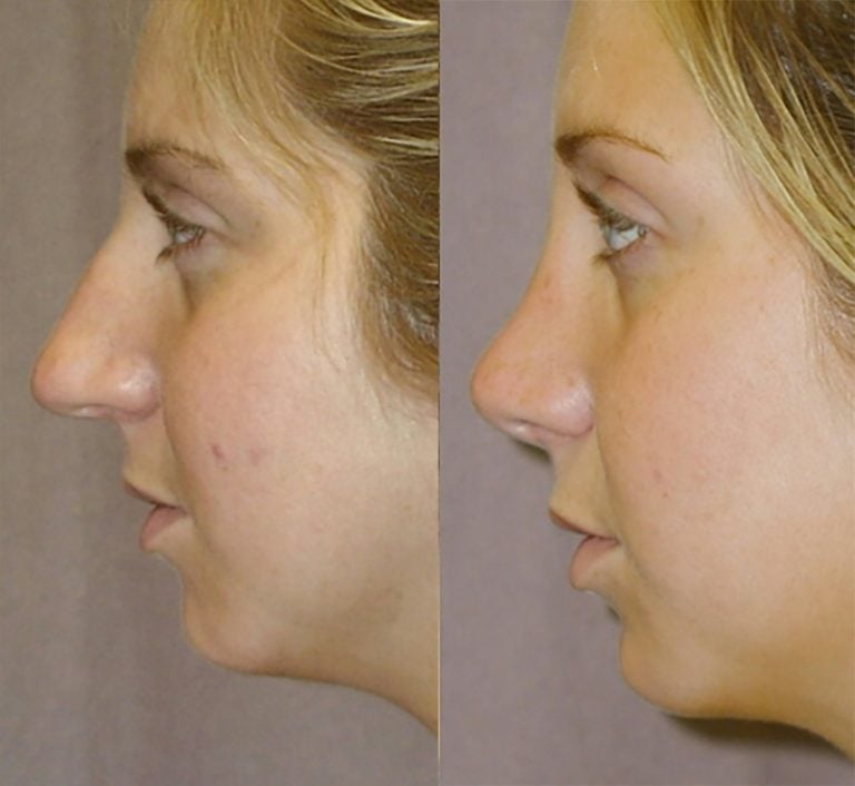 Rhinoplasty - side