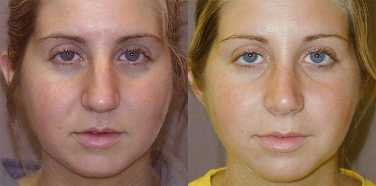 rhinoplasty-closed
