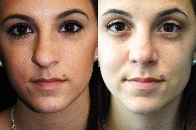 rhinoplasty-front-view