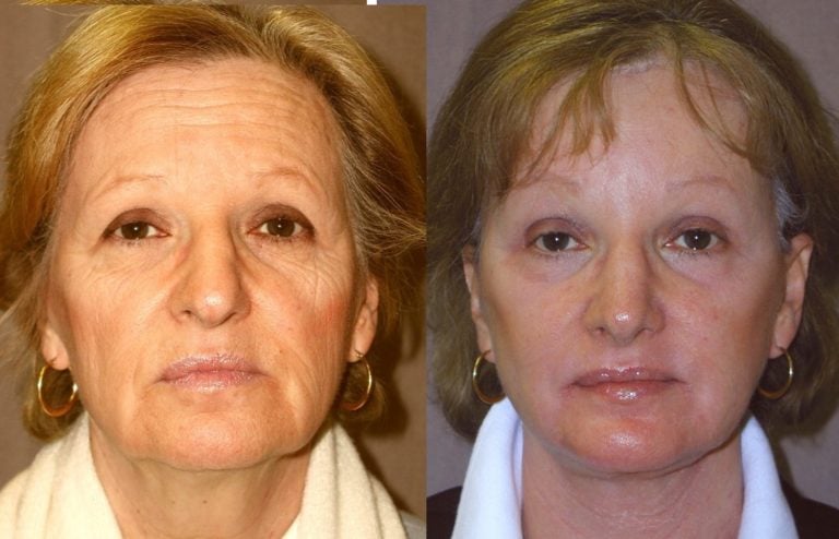 rhinoplasty-no-fracture-chin-implant-browlift-facelift