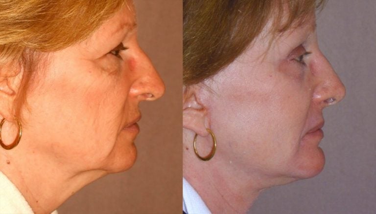 Rhinoplasty-no-fracture-chin-implant-browlift-facelift-side