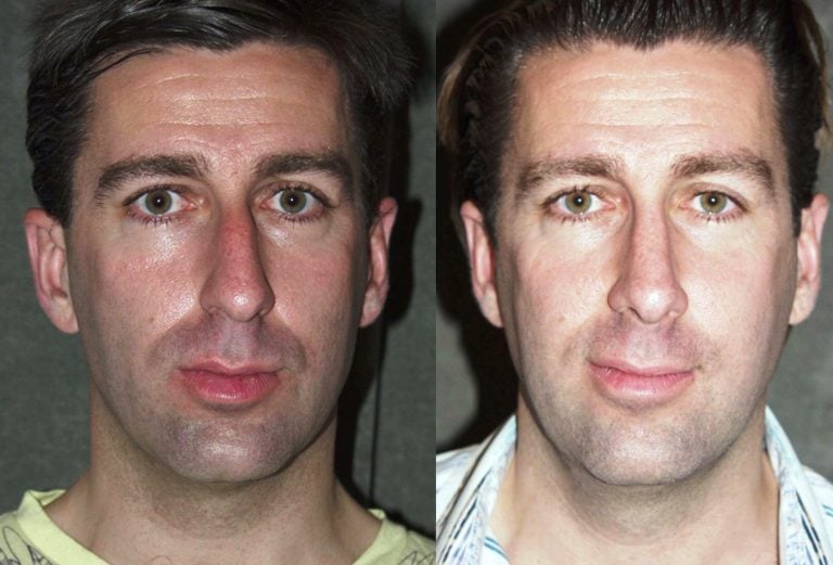 Rhinoplasty one year follow-up front view