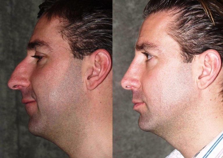 Rhinoplasty one year follow-up side view