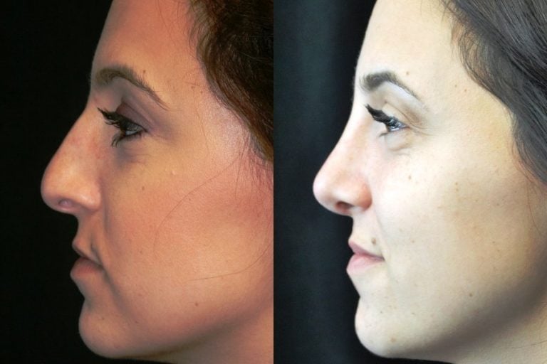 Rhinoplasty patient - side view