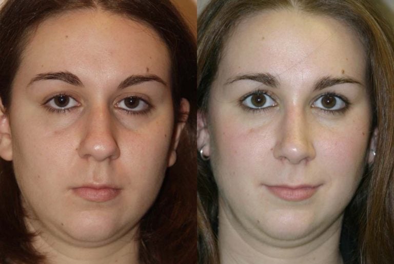 rhinoplasty bulbous tip, small bump change
