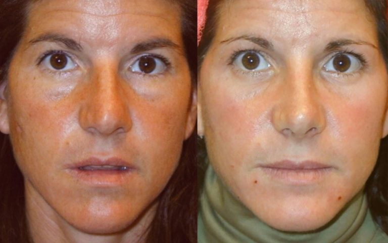rhinoplasty, small hump and tip reduction