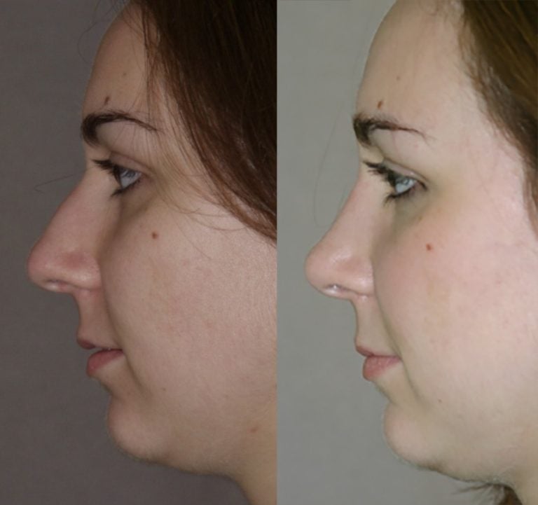 Rhinoplasty bulbous tip, small bump, side