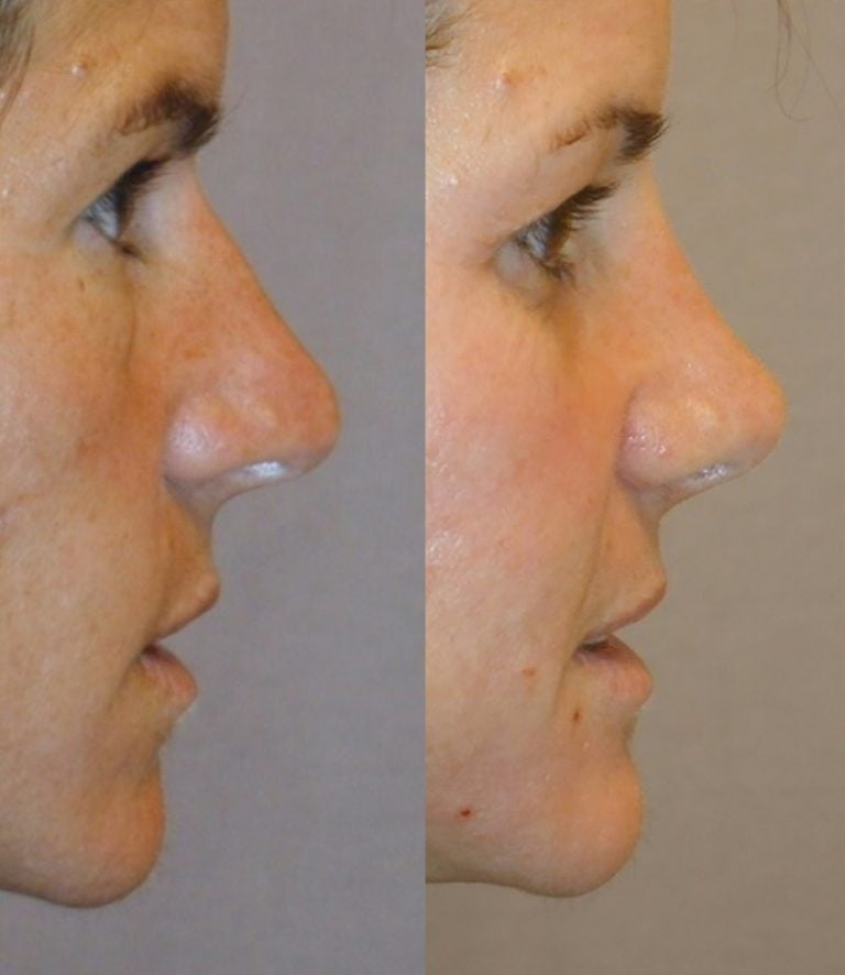 Rhinoplasty, small hump and tip reduction, side