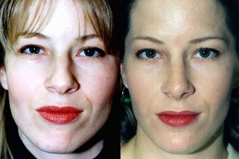 rhinoplasty-with-chin-implant-front