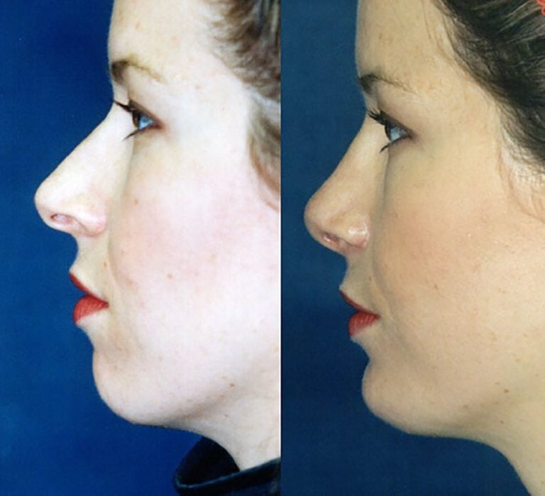 Rhinoplasty-with-chin-implant-side