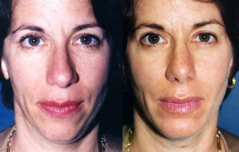 rhinoplasty-without-fracture-chin-augmentation