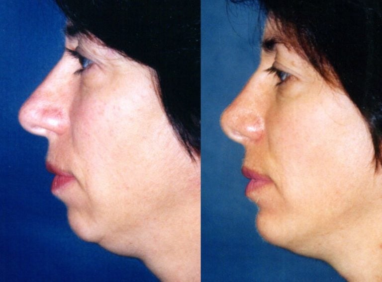 Rhinoplasty-without-fracture-chin-augmentation-side