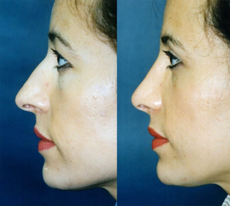 Rhinoplatsy-14-side