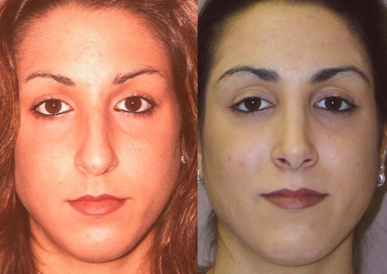 rhinoplasty closed