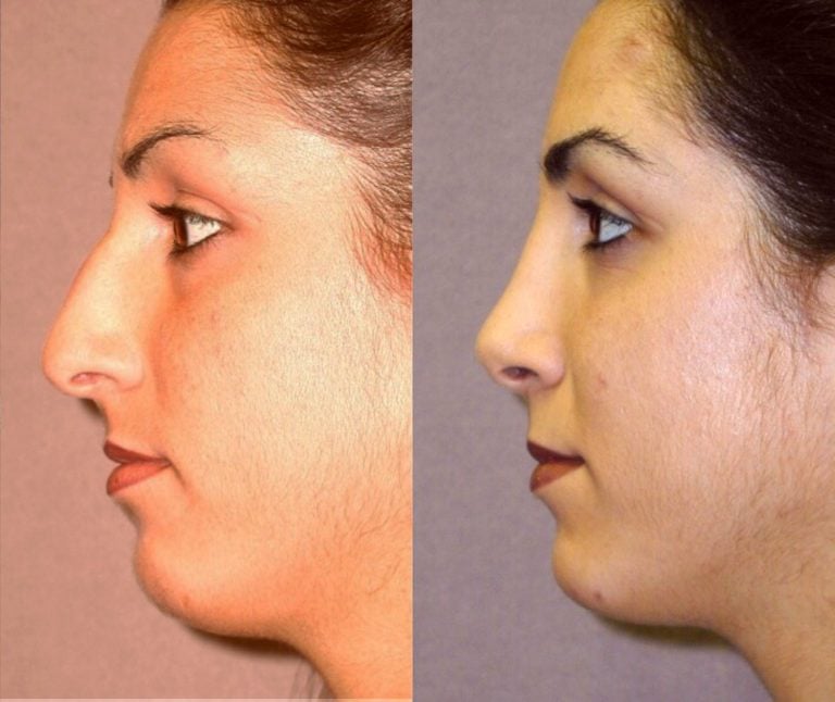 Rhinoplasty closed, side