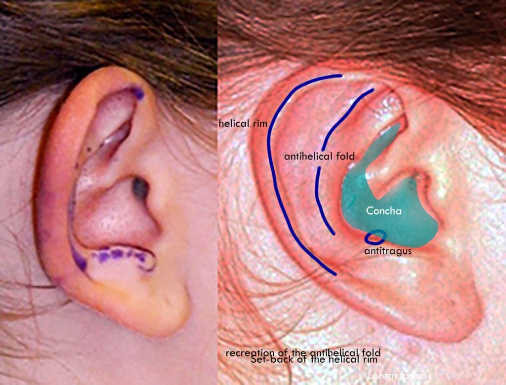 Right ear with markings for surgery and labels of anatomical landmarks