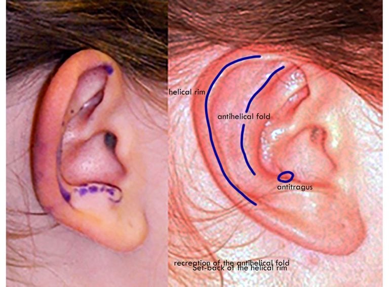 Right ear with markings for surgery and labels of anatomical landmarks