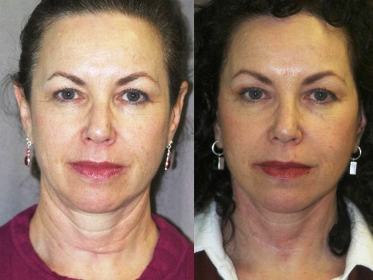 short-scar-facelift-with-correction-of-thyroidectomy-scar-in-lower-neck-front-view