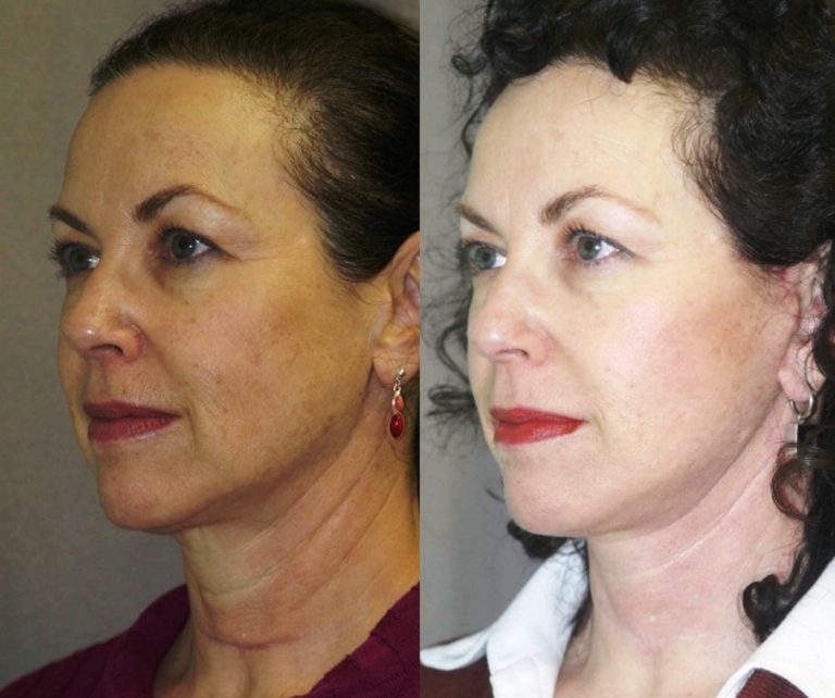 short-scar-facelift-with-correction-of-thyroidectomy-scar-in-lower-neck-oblique-view