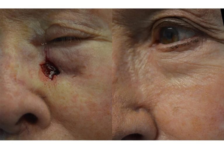 Skin cancer closure with local rhomboid skin flap