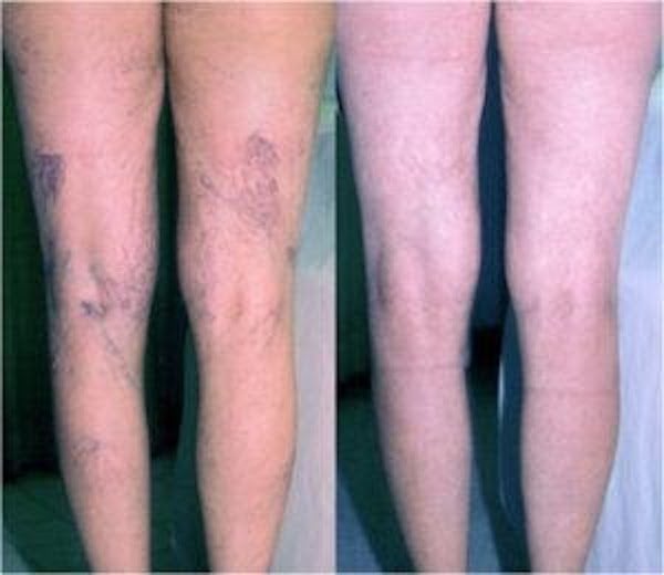 Treatment: Injection sclerotherapy is performed with a 30-gauge needle or smaller. Magnification and a surgical light are required to inject spider vessels. Elastic compression stockings are worn after treatments. There is no limitation on walking.