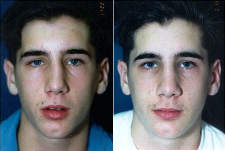 Sports injury, crooked nose and bump on the bridge. The projection and size of the tip was also reduced so that the bridge and the tip are now in line with each other. Front view.