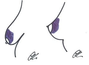 Superior pedicle side view before and after