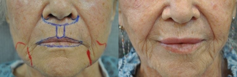 Surgical planning upper lip shortening, fat injection, peri-oral peel, liposuction of jowls