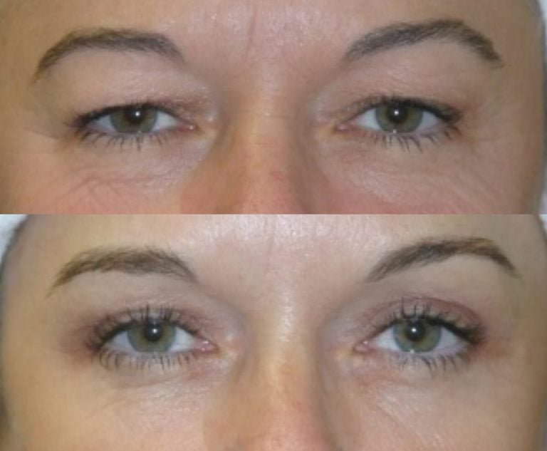 This patient’s eyes look much younger and more attractive after upper and lower blepharoplasty. 