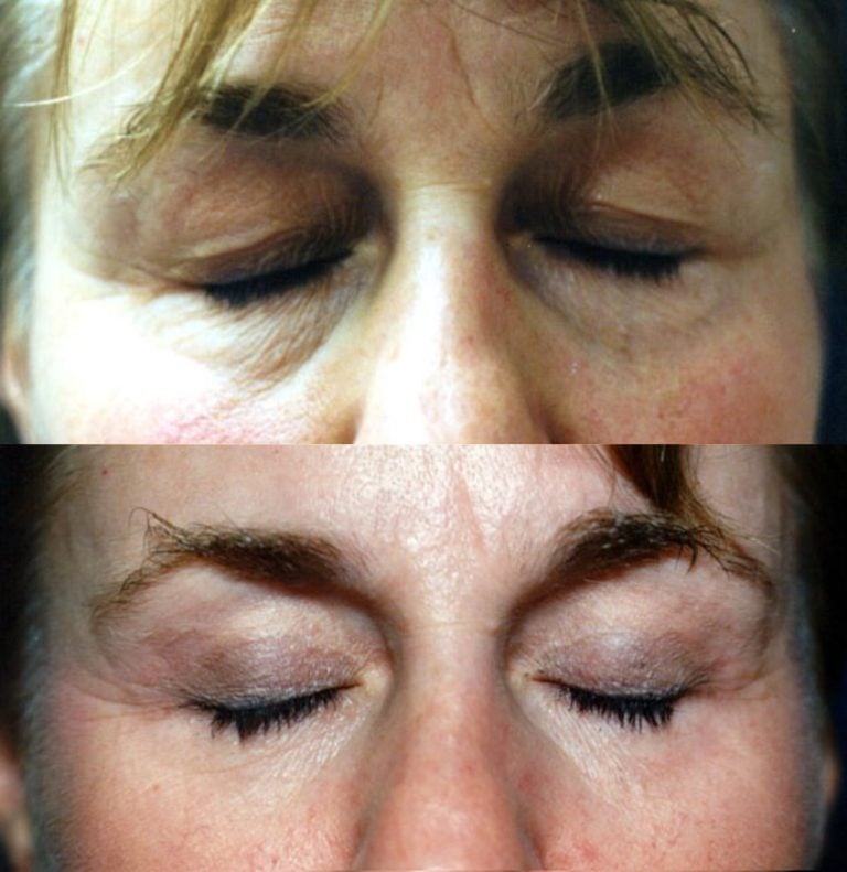 The same patient with eyes closed