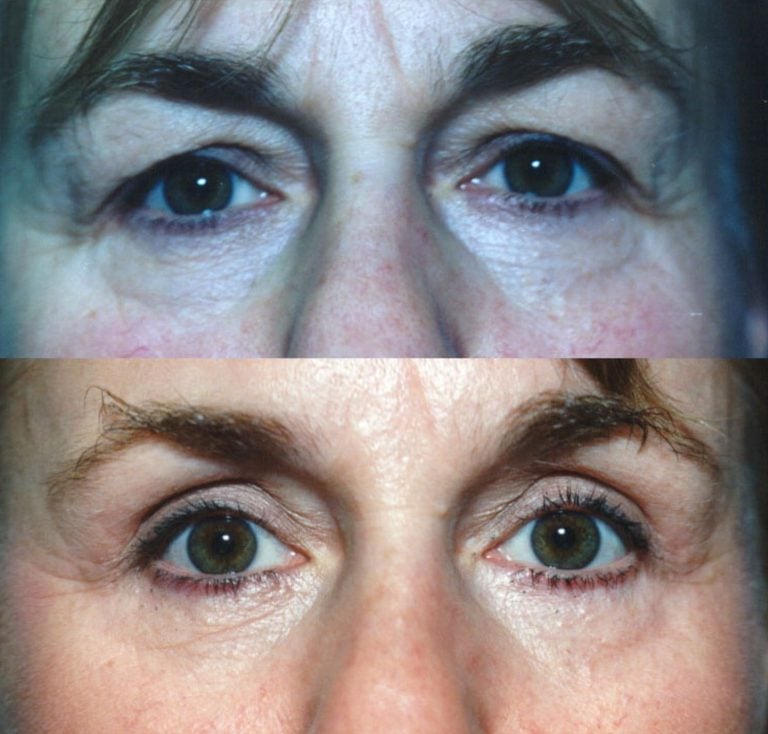 The forward gaze of a patient who had undergone upper and lower blepharoplasty