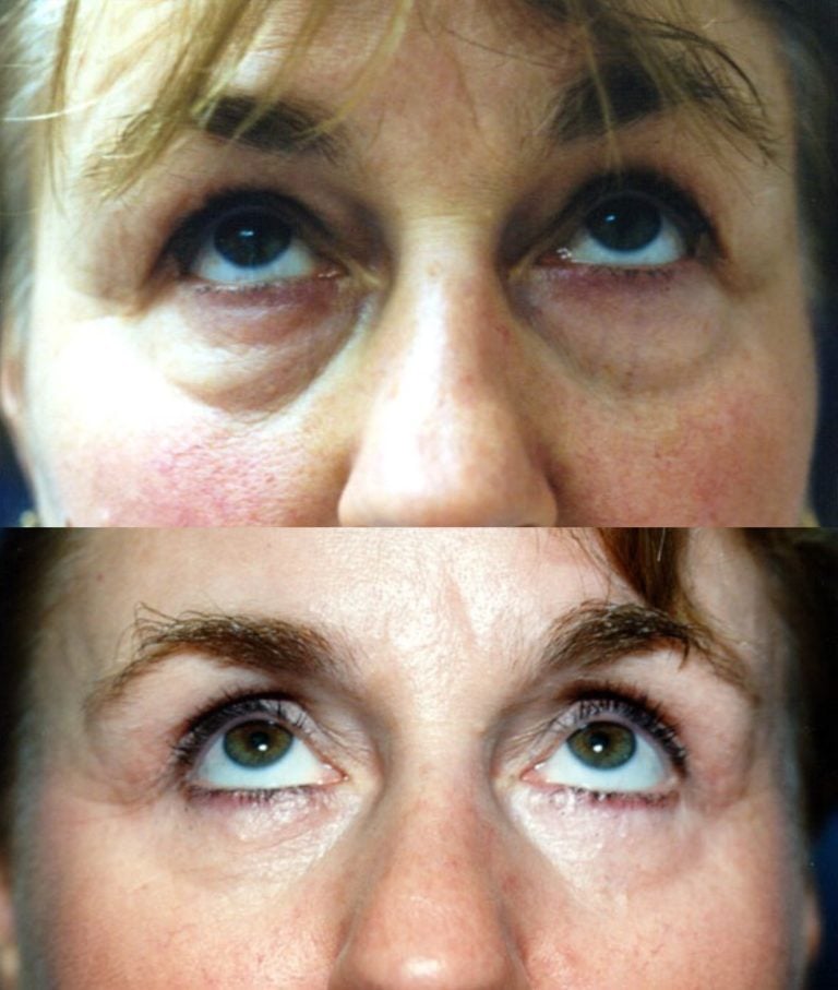 The upward gaze of the same patient
