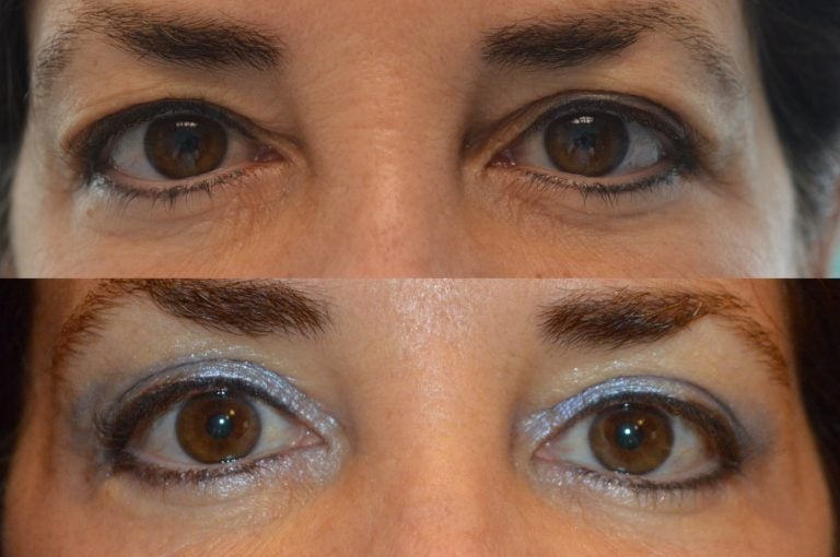 This patient has undergone upper blepharoplasty, performed under local anesthesia.