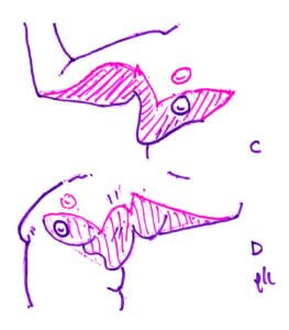 Upper body lift with excision fo gynecomastia combined with brachioplasty C D