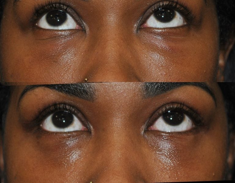 The same patient looking upwards