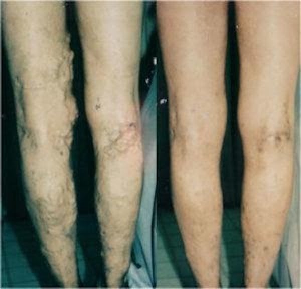 Varicose Veins