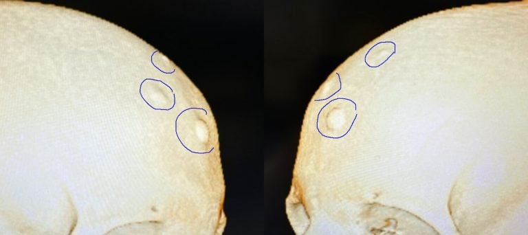 48-year-old two weeks after endoscopic removal of osteoma, 3D CAT scan with marking obliques