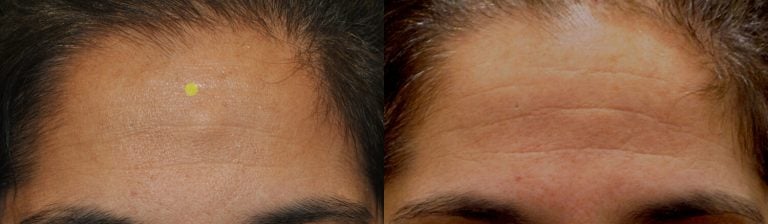 48-year-old two weeks after endoscopic removal of osteoma, front