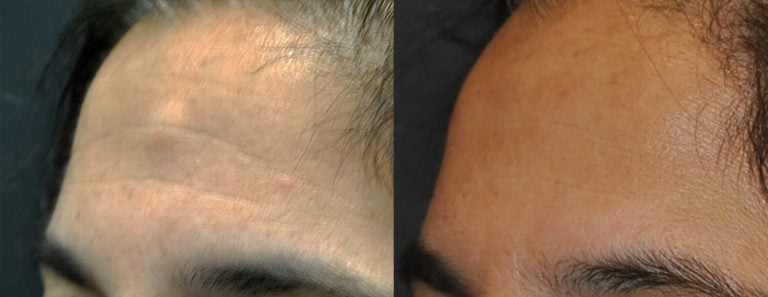 48-year-old two weeks after endoscopic removal of osteoma, left oblique