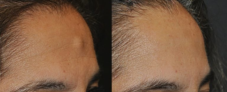 48-year-old two weeks after endoscopic removal of osteoma, right oblique