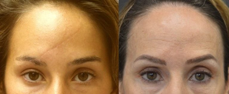 Faded scar 23 years after scar revision using ‘W’ plasty technique.