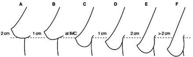 [See Figure 1 to stage the Breast Ptosis between A and F. Stage the Ptosis A-F depending on how many centimeters the nipple is above or below the crease.]