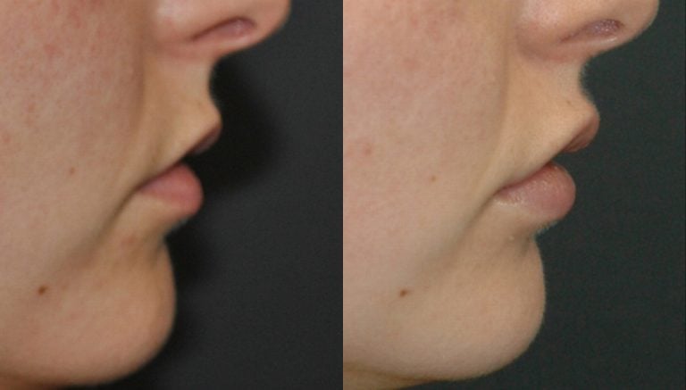 23 year-old, lip flip, juvederm Ultra-Plus upper and lower lips, 5 days lips only