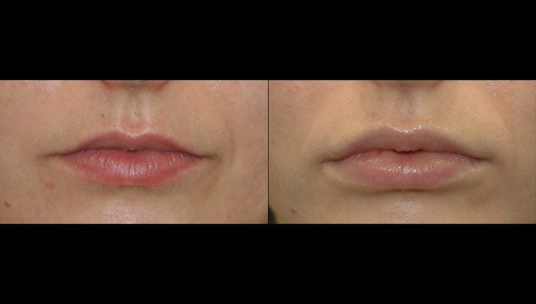 23 year-old, lip flip, Juvederm Ultra-Plus upper and lower lips, 5 days, mouth closed