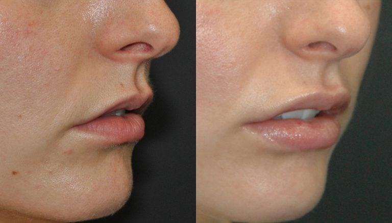 23 year-old, lip flip, Juvederm Ultra-Plus upper and lower lips, 5 days, oblique