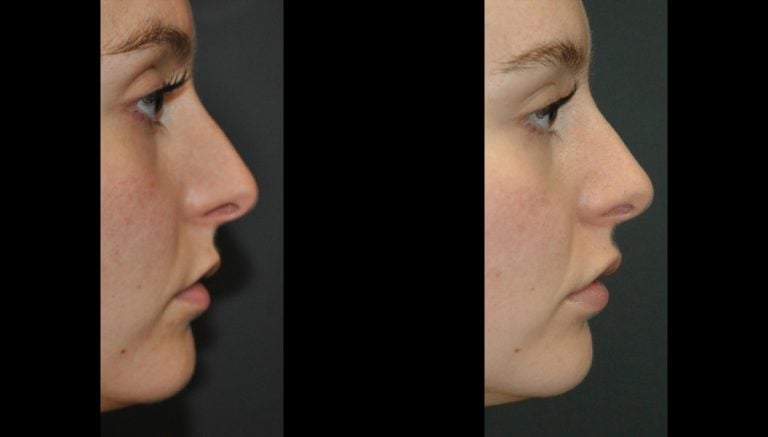 23 year-old, lip flip, juvederm Ultra-Plus upper and lower lips, 5 days