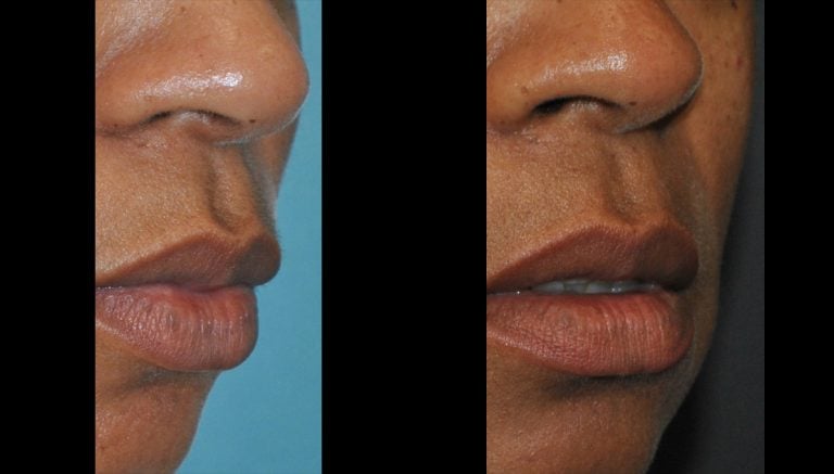 Lip Flip before and after oblique - 1