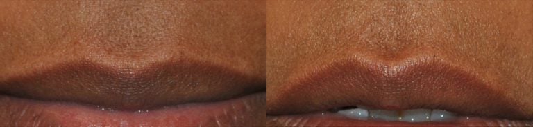 Lip Flip before and after oblique - 2